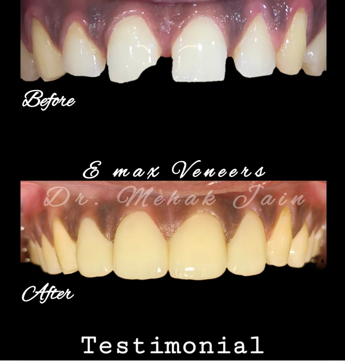 E-max Veneers Makeover