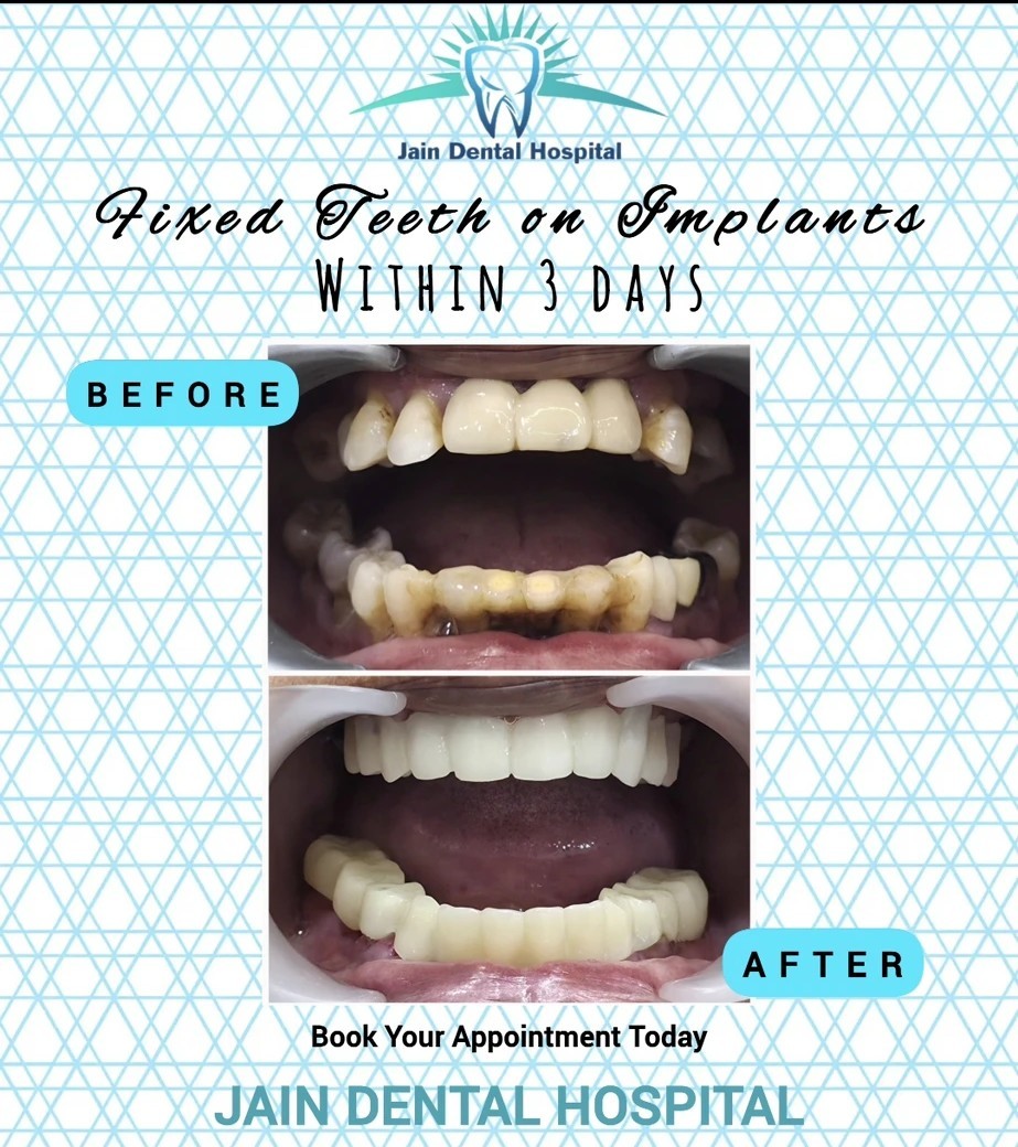 Fixed Teeth on Implants in 3 Days