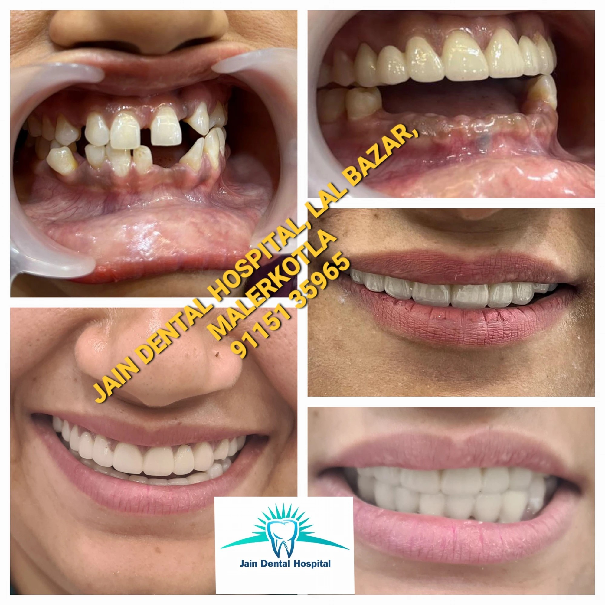 Complete Smile Makeover