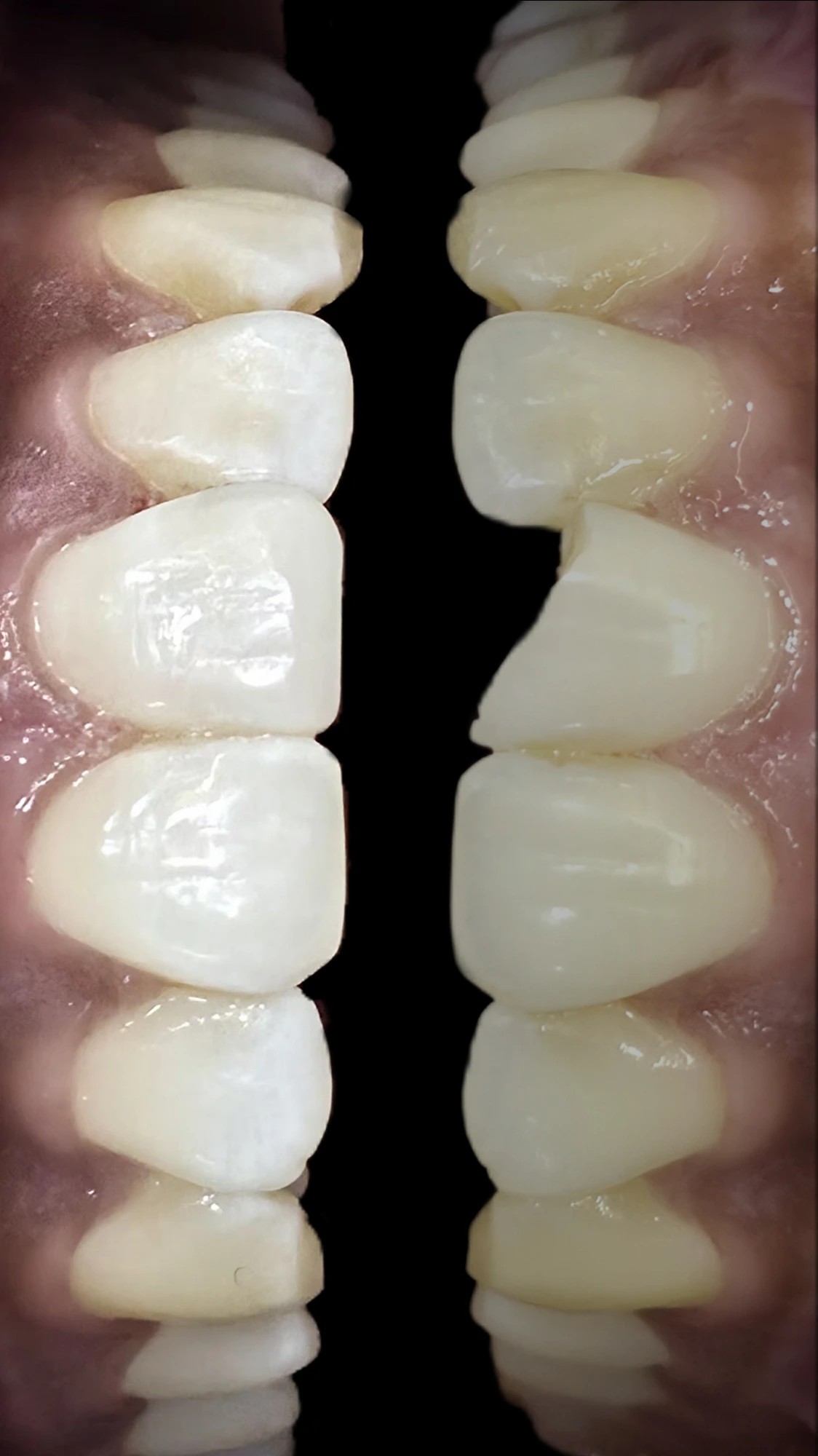 Veneers Symmetry